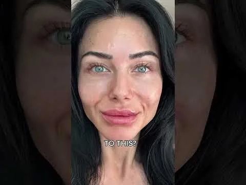 Biostimulator treatment video at Hollywood Clinic