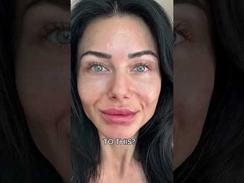 Biostimulator before and after results at Hollywood Clinic