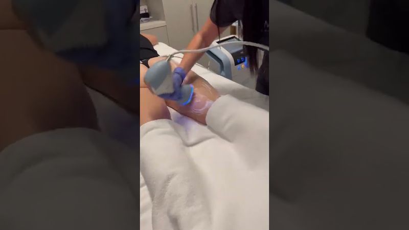 EMTONE — cellulite reduction at Hollywood Clinic