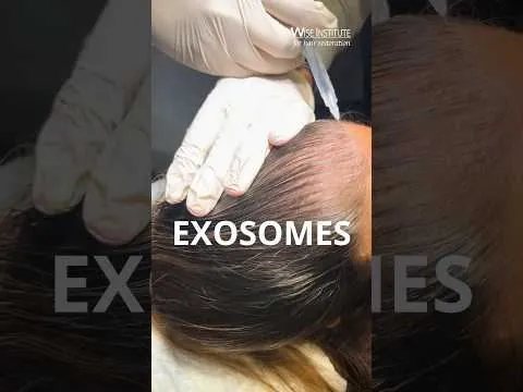 Exosomes hair treatment video at Hollywood Clinic