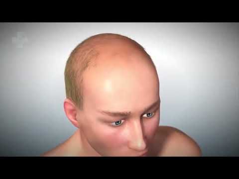 Exosomes hair treatment at Hollywood Clinic