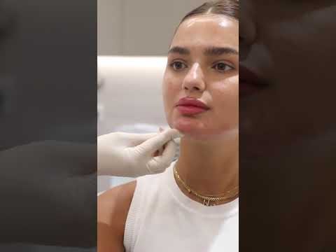 Chin and jawline definition with fillers at Hollywood Clinic