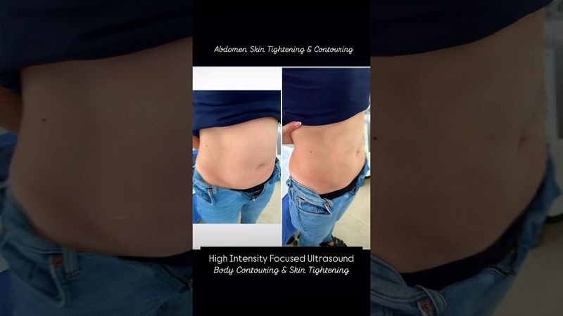 HIFU Body — body contouring session