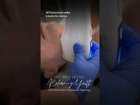 HIFU facial treatment video at Hollywood Clinic