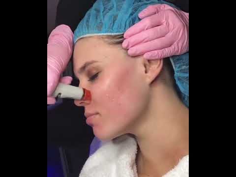 HydraFacial treatment at Hollywood Clinic