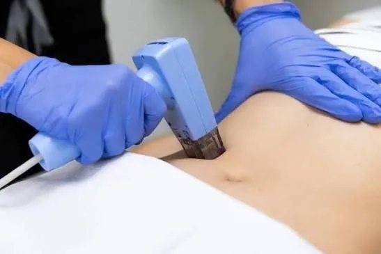 Morpheus8 Body applicator treating the abdomen