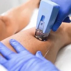 Morpheus8 Body microneedling applicator in use