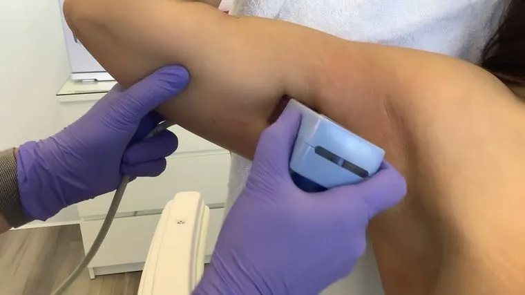 Morpheus8 Body — how the treatment works