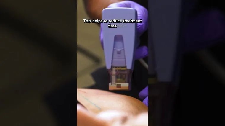 Morpheus8 Body — inside a skin-tightening session