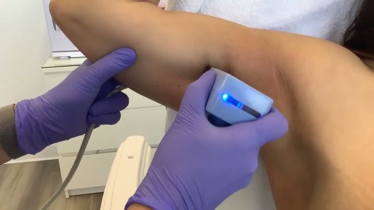 Morpheus8 Body — treatment on the arms
