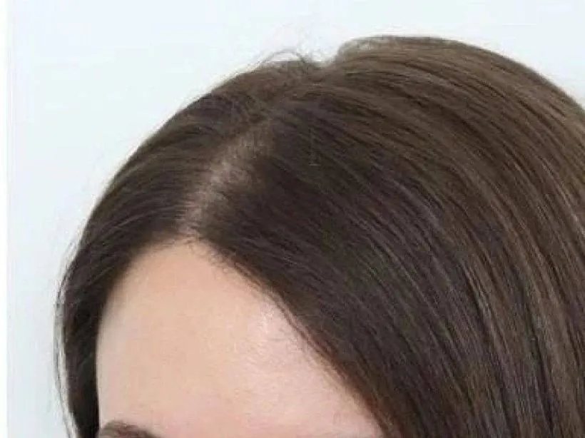 After hair loss treatment — fuller hairline